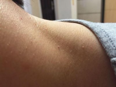 ​脖子上长肉疙瘩是怎么回事(脖子上长肉疙瘩是什么原因引起的)