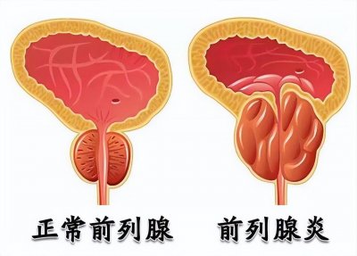 ​一位患者自述：我的人生，全被前列腺炎毁了