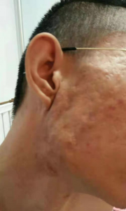 ​痤疮瘢痕 长痘留下难看的疤痕前，没人告诉你这些