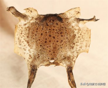 ​蟾蜍皮能治疗癌症吗 原来癞蛤蟆皮也能用于抗癌，比如这名10年未复发的胃间质瘤