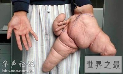 ​世界上最大的手指
