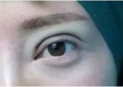 ​割双眼皮花了3万块 我做了双眼皮花了28000贵吗