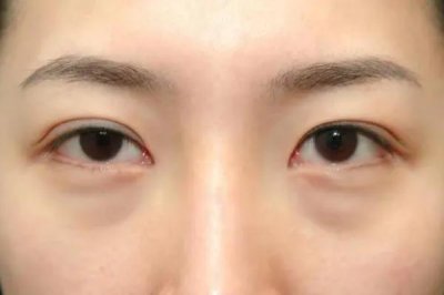 ​眼袋怎么去除最有效果 眼袋的形成原因
