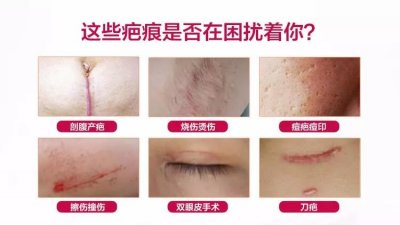 ​祛疤膏哪个牌子好？十款知名度最高的祛疤产品