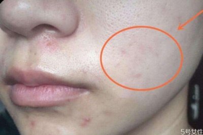 ​黑色痘印能自己消失吗 黑色痘印自己可以消失吗