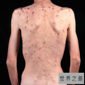 ​盘点世界五大绝症，如不解决恐毁灭人类