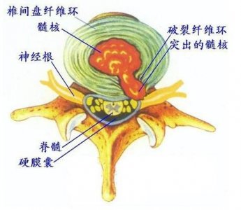 ​腰椎突出严重怎么办怎么治疗（腰间盘突出怎么治疗，不花钱在家就可以解决）