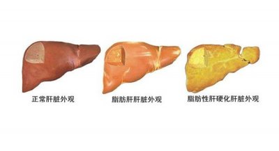 ​脂肪肝不能吃什么 脂肪肝患者的饮食禁忌