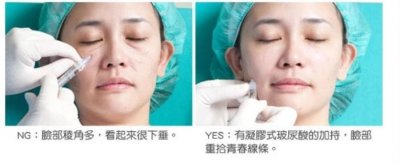 ​注射除皱的方法（注射除皱的危害是什么）