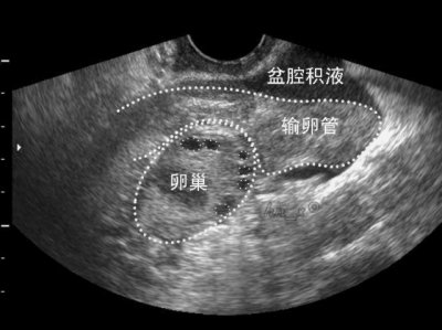 ​盆腔积液怎么治疗 体检查出“盆腔积液”怎么办？三类女性很常见，4个防御措施