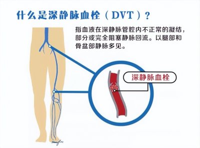 ​什么是深静脉血栓（DVT），有什么症状？怎么治？